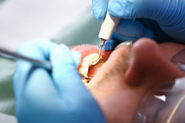 Best Emergency Dental Care for Broken or Chipped Teeth in Beale Af, CA