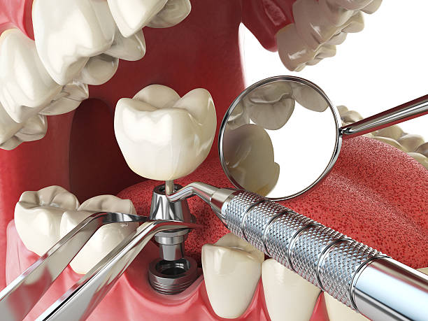 Best Emergency Wisdom Teeth Removal in Beale Af, CA